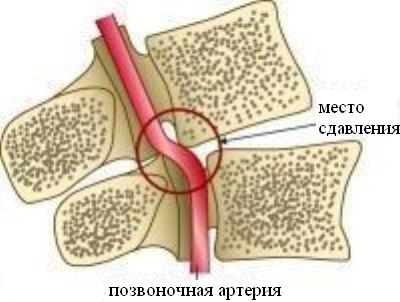 A nyaki osteochondrosis okai, tünetei és kezelése