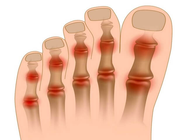 A láb ízületeinek ízületi gyulladása lapos lábakkal, Gyermekgyógyászati kézikönyv II.