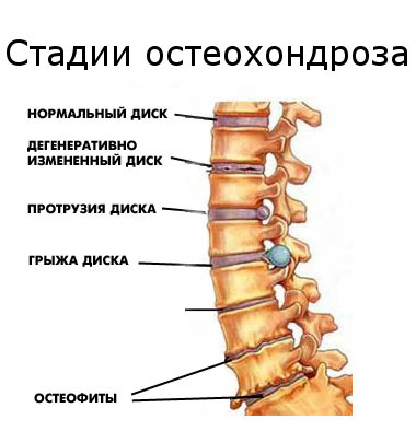 A nyaki gerinc osteochondrosisa enyhíti a fájdalmat